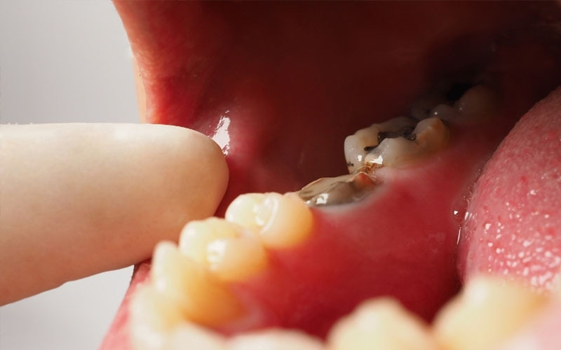 Frequent Cavity Problems: Reduce Sugar and Improve Daily Cleaning